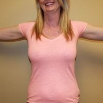 Liposuction Case 2 - After