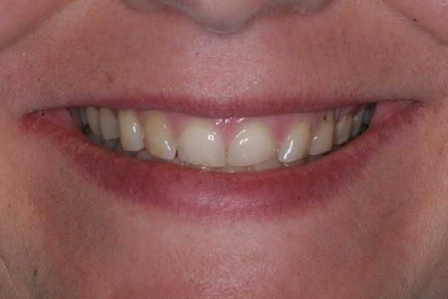 Veneers and Crowns: Case 1 - Columbus, GA - Before