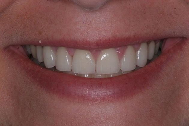 Veneers and Crowns: Case 1 - Columbus, GA - After