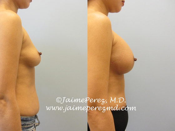 Breast Augmentation: 325cc - Silicone Implants