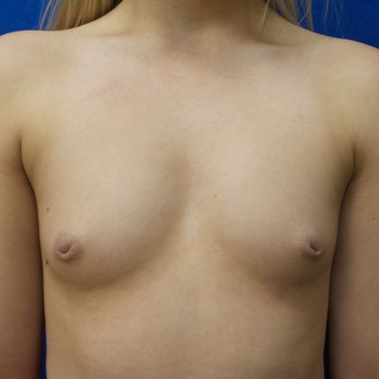 Breast Augmentation Case 8 - Before