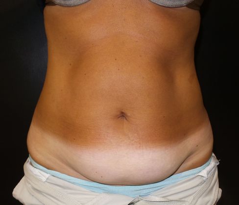 Tummy Tuck Case 15 - Before