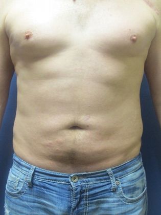 Liposuction Case 7 - After