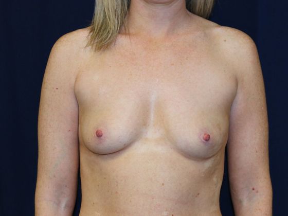 Breast Augmentation*: Case 51 - Before