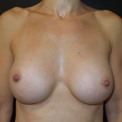 Breast Augmentation Case 13 - After