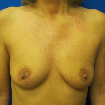 Breast Augmentation Case 11 - Before