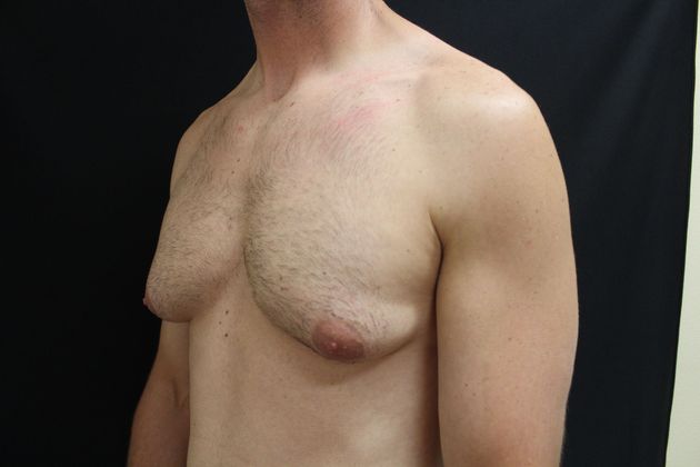 Gynecomastia: Case 6 - Before
