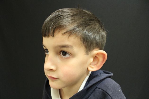 Ear Surgery - Otoplasty: Case 3 - Before