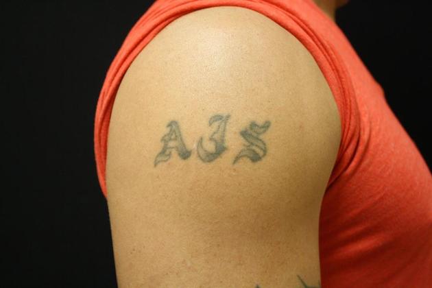 Laser Tattoo Removal Case 1 - Before