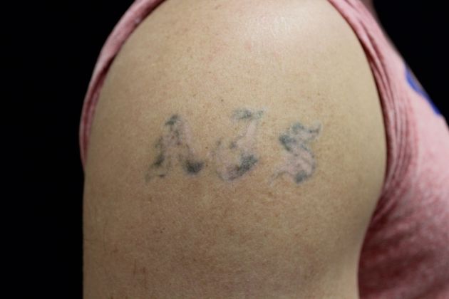 Laser Tattoo Removal Case 1 - After