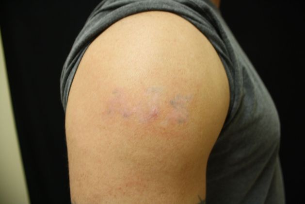 Laser Tattoo Removal: Case 1 - After Treatment 2