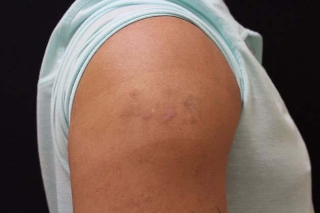 Laser Tattoo Removal: Case 1 - After Treatment 3