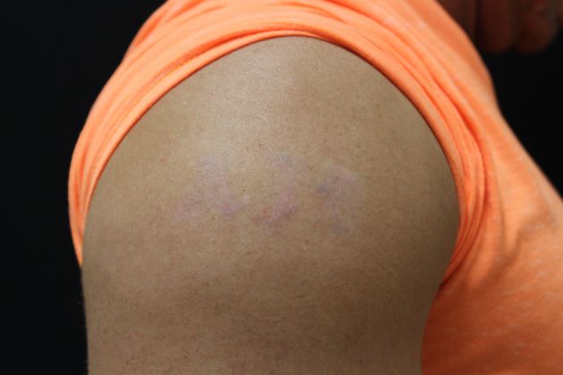 Laser Tattoo Removal: Case 1 - After Treatment 4