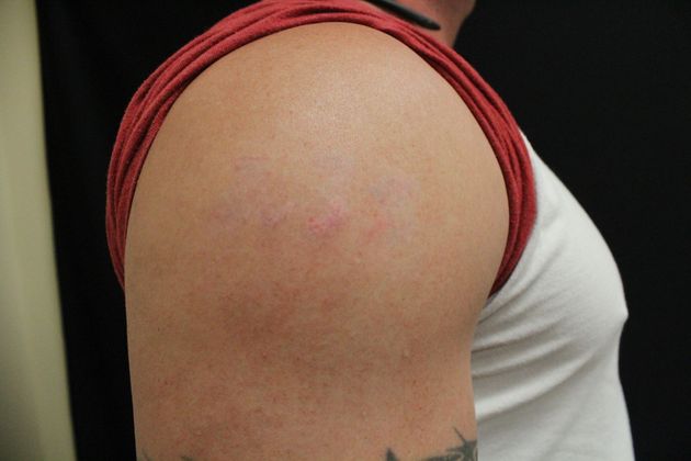 Laser Tattoo Removal: Case 1 - After Treatment 5