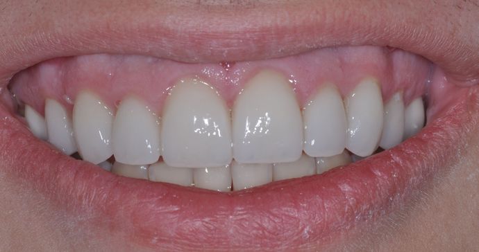 Dental Crowns Case 2 - After