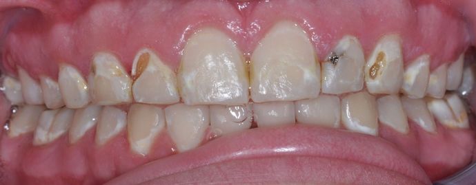 Dental Crowns Case 2 - Before