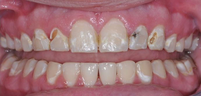Dental Crowns: Case 2 - Before