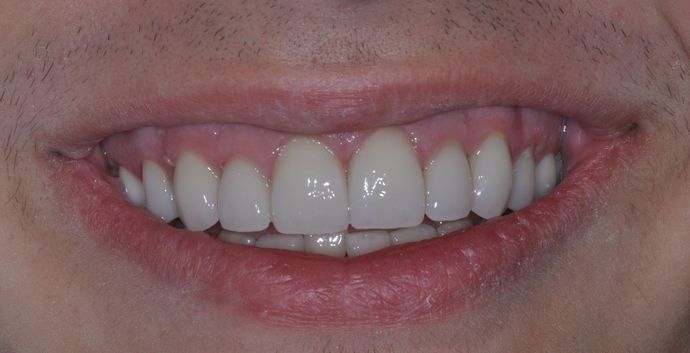 Dental Crowns: Case 2 - After