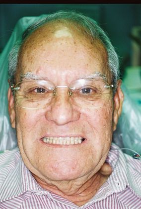 Dental Crowns Case 1 - Before