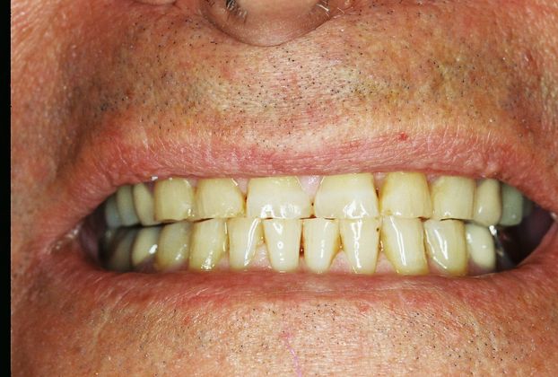 Dental Crowns: Case 1 - Before