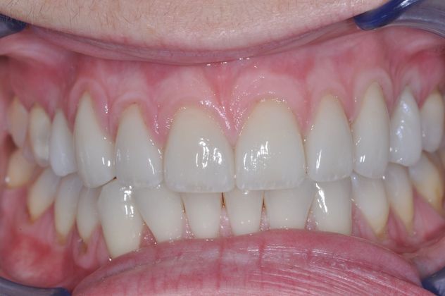 Veneers Case 2