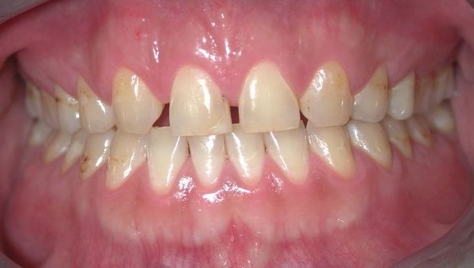 Veneers Case 3 - Before