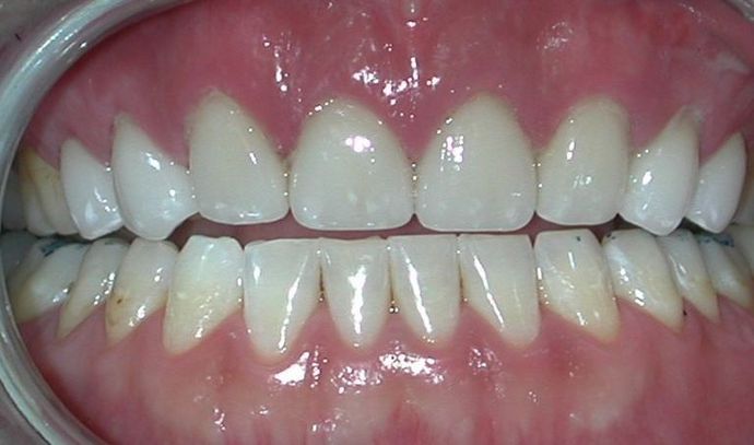 Veneers Case 3 - After