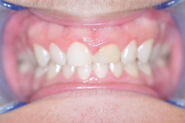 Gum Lift Case 4/609 - Before