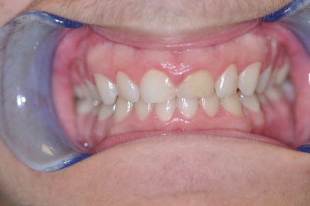 Gum Lift: Case 4/609 - Before