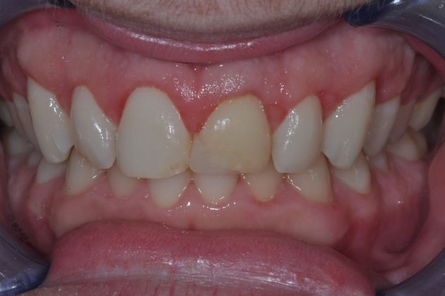 Gum Lift Case 4/609 - After