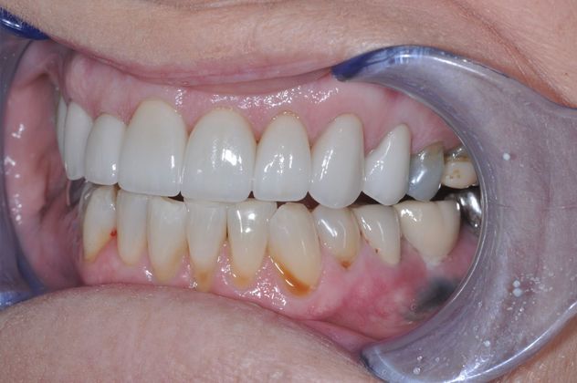 Dental Crowns Case 3 - After