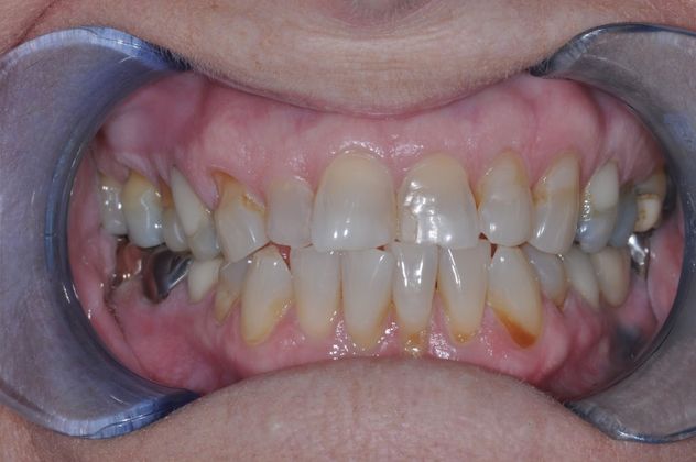 Dental Crowns Case 3 - Before