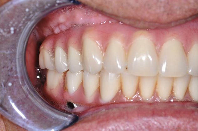 Dentures All On 4 Fixed Denture - After