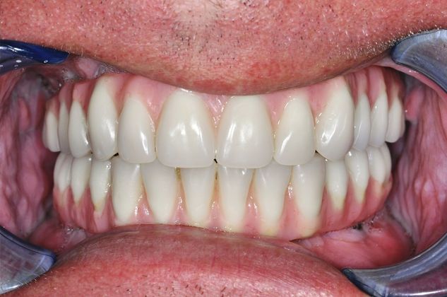 Dentures: All On 4 Fixed Denture