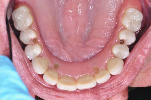 Dentures: All On 4 Fixed Denture