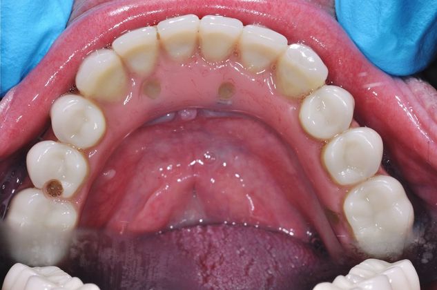 Dentures: All On 4 Fixed Denture