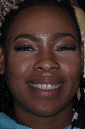 Gum Lift: Case 3 - Before