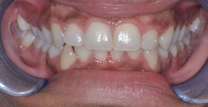 Gum Lift Case 3 - Before