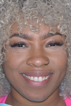 Gum Lift: Case 3 - 1 Month After Treatment