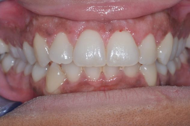 Gum Lift Case 3 - After