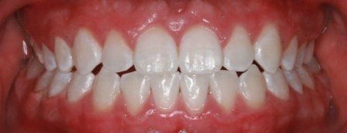 Whitening Cases