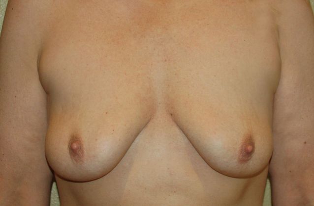 Breast Augmentation w/ Lift Case 134 - Before