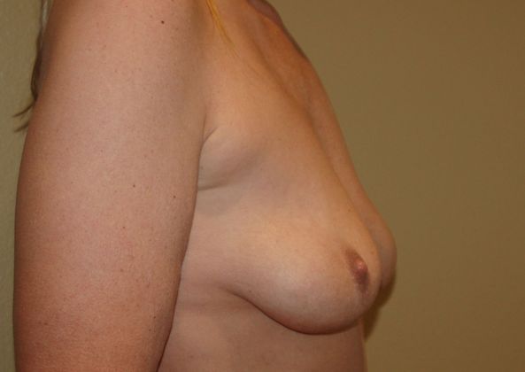 Breast Augmentation w/ Lift: Case 134 - Before