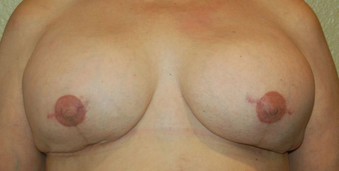 Breast Reconstruction Case 48 - After
