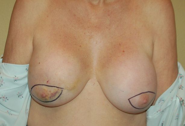 Breast Reconstruction Case 49 - Before