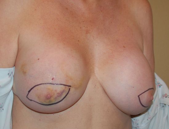 Breast Reconstruction: Case 49 - Before
