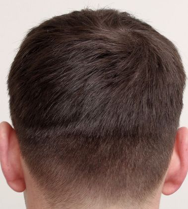 Donor Area After Hair Transplant Photos FUE