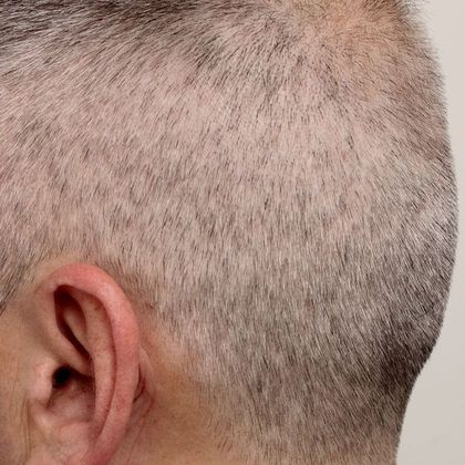 Hair Transplant - Donor Area Afters: FUE - Donor area after FUE