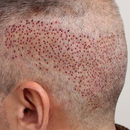 Hair Transplant - Donor Area Afters: FUE - Post-op FUE