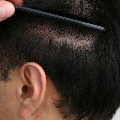 Donor Area After Hair Transplant Photos: FUE - Donor area after FUE